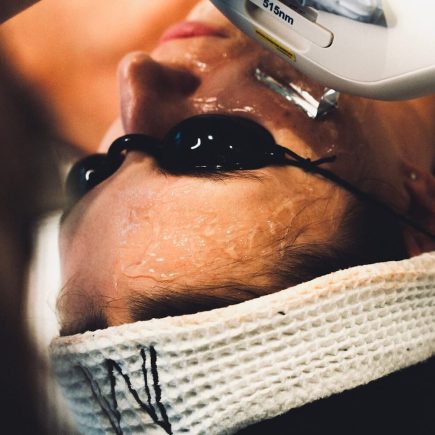 twarz kobiety w okularach ochronnych w trakcie zabiegu laserem